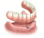 Digital illustration of implant retained dentures that snap on to two implants on the lower jaw