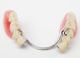 An example of a prosthetic partial denture that is made out of metal and acrylic